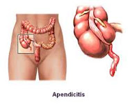 Como saber si tengo apendicitis en casa